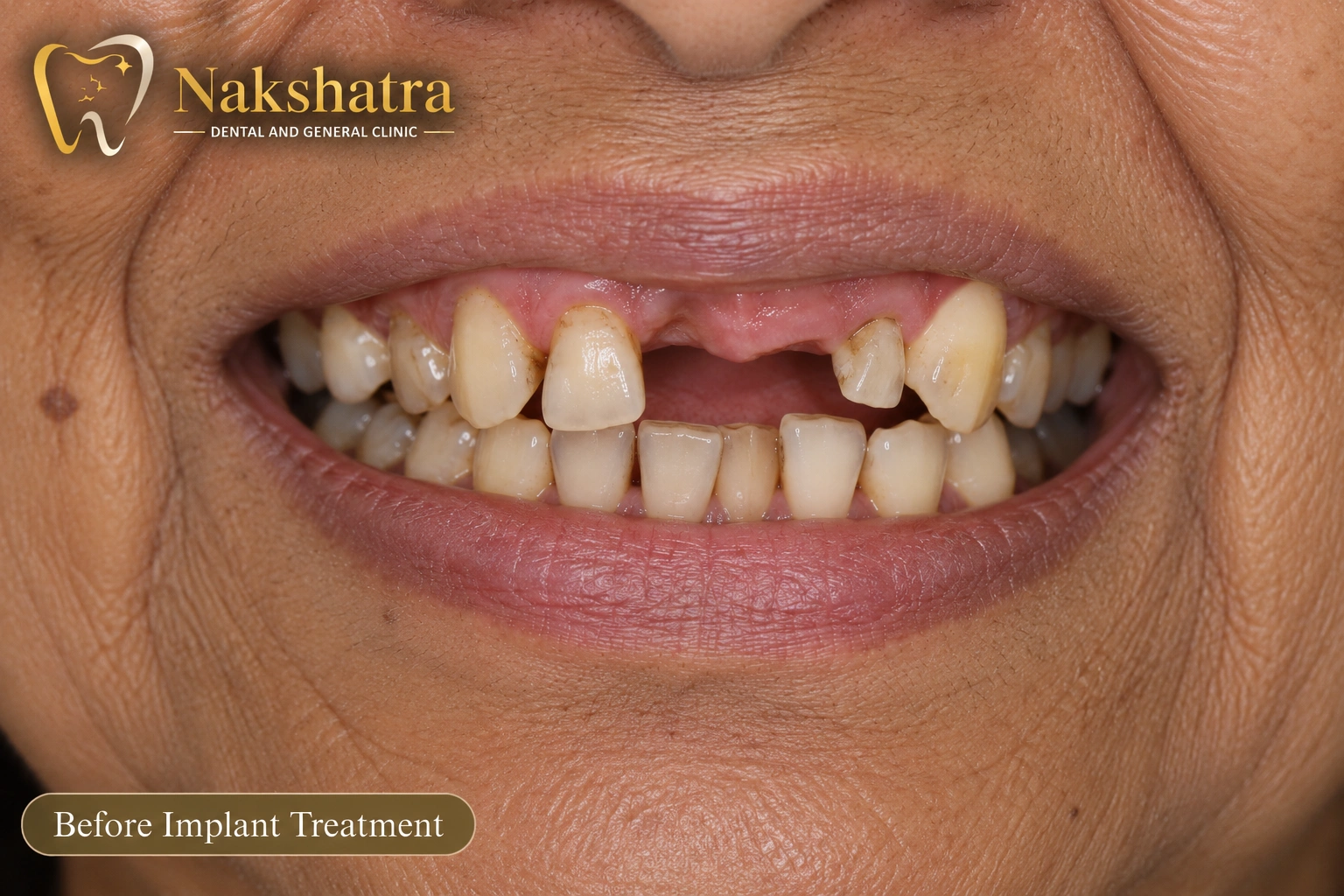 Before dental smile transformation, case 2